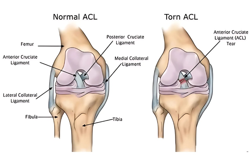 ACL Tear
