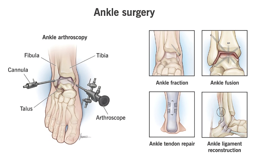 Ankle replacement