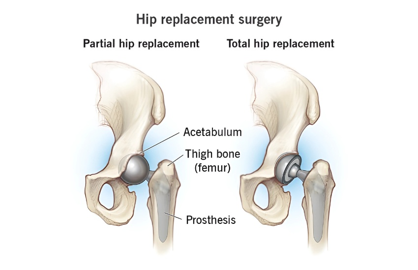 Hip replacement