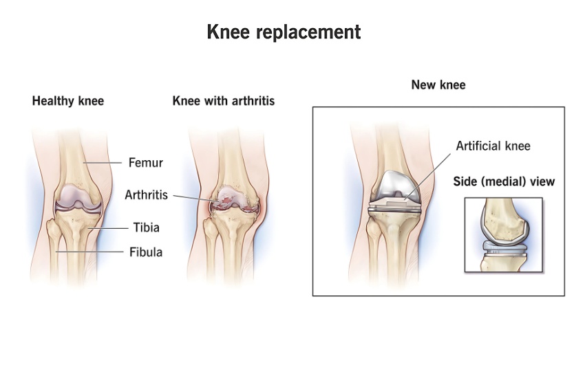 Knee Replacement