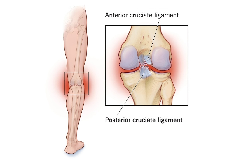 PCL tear