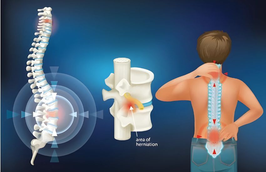 Spinal Cord Injuries