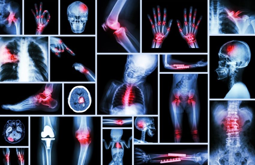 Orthopedic Trauma Injuries