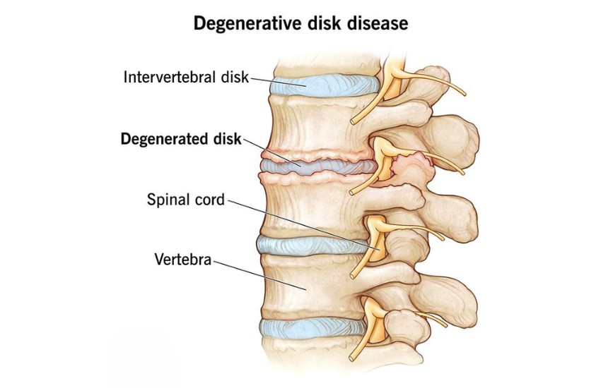 Degenerative dics disease