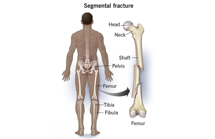 fracture fixation